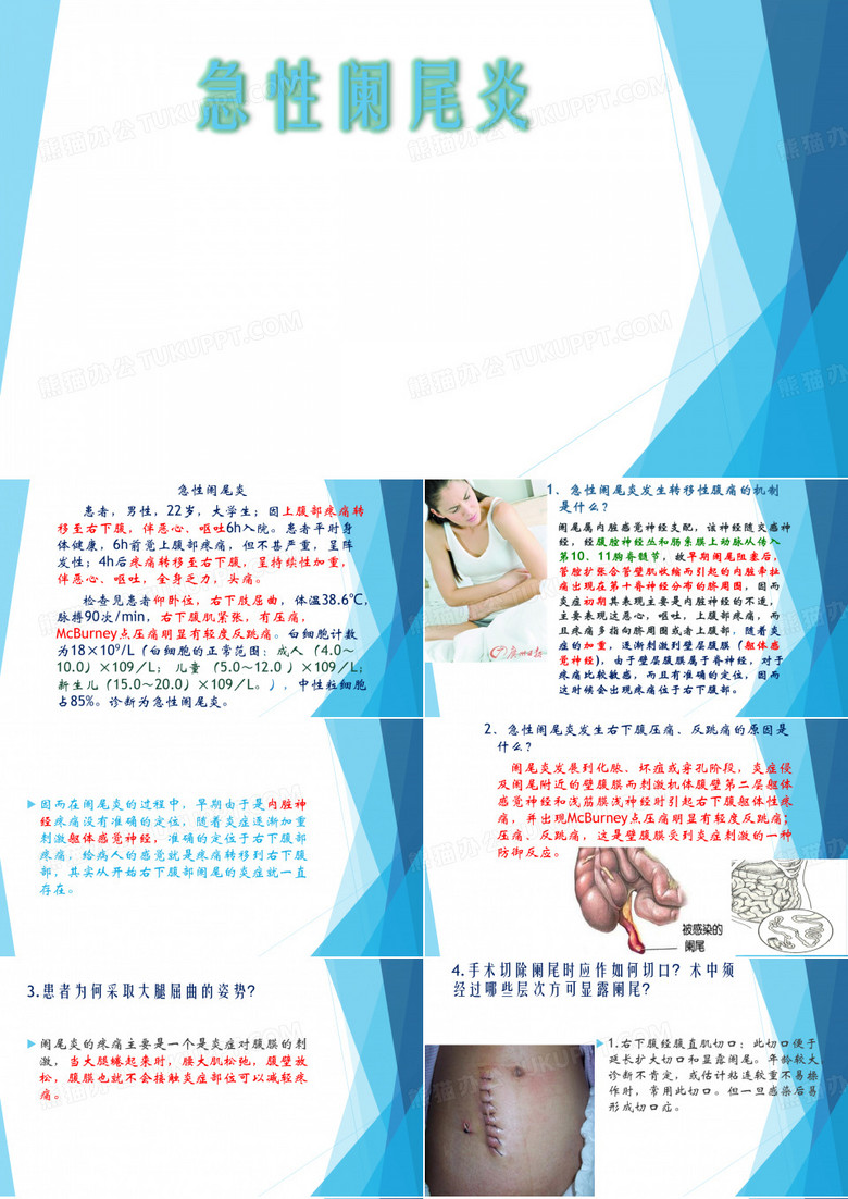 急性阑尾炎