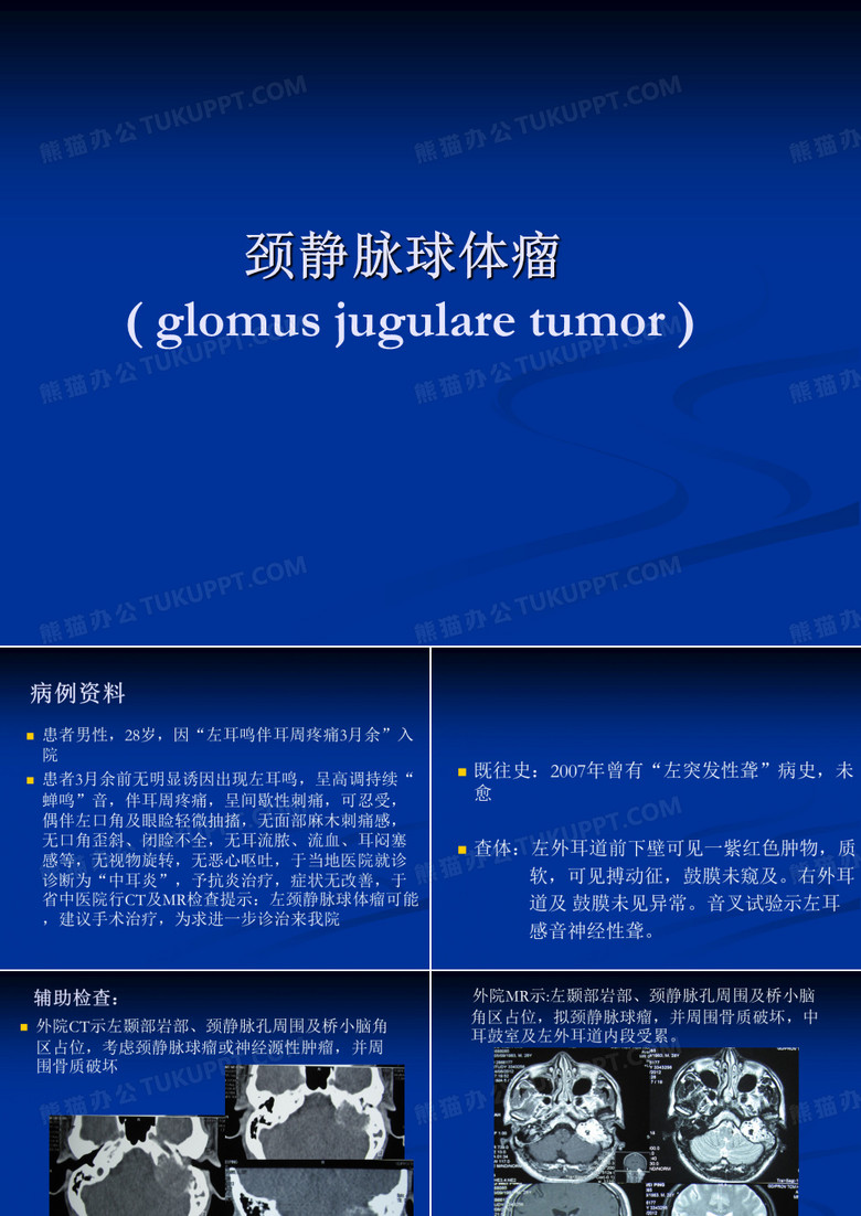 颈静脉球体瘤