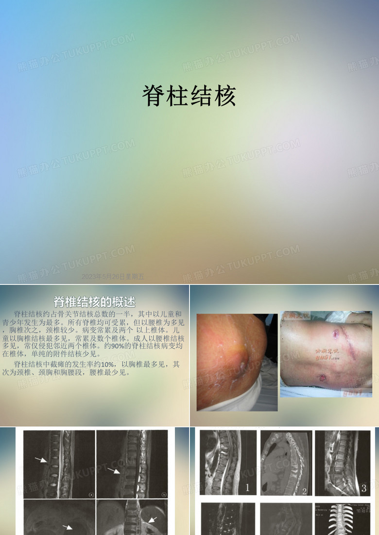 脊柱结核