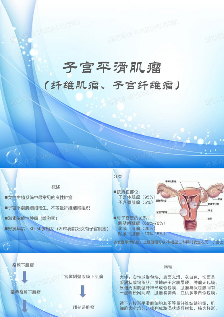 子宫平滑肌瘤