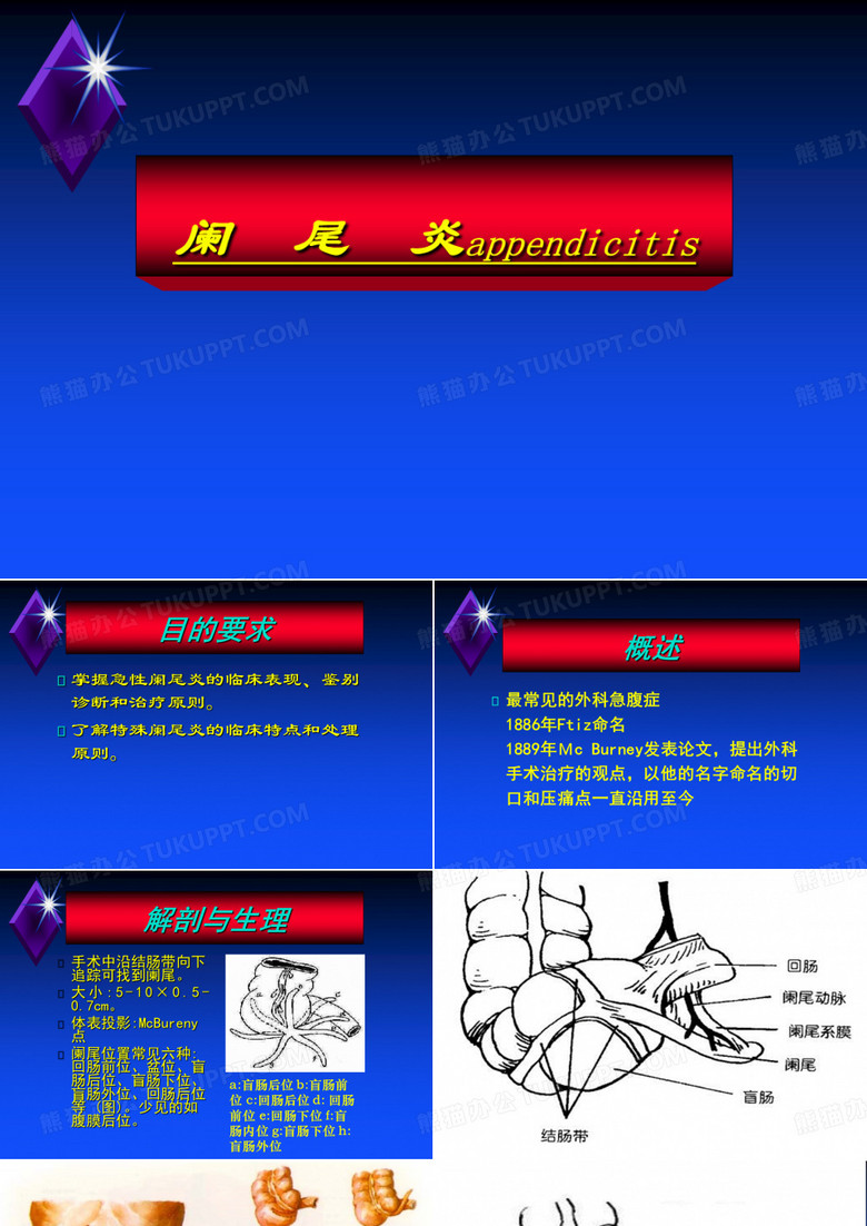 急性阑尾炎PPT
