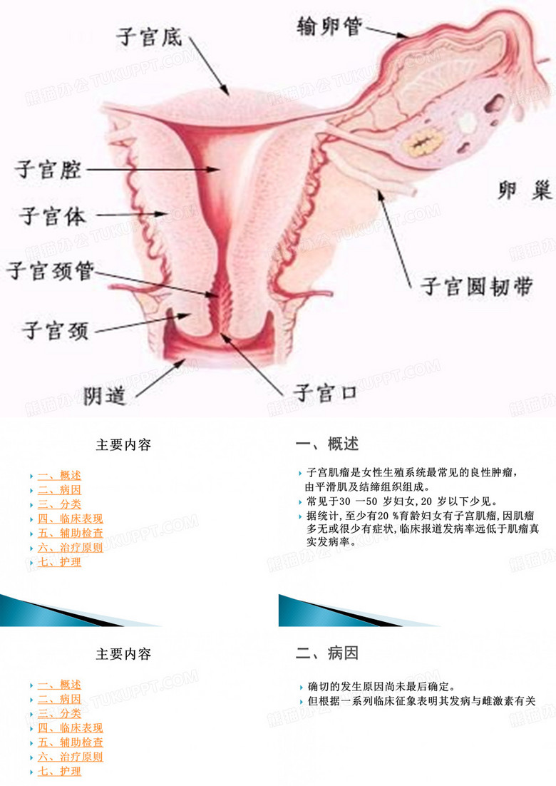 子宫肌瘤