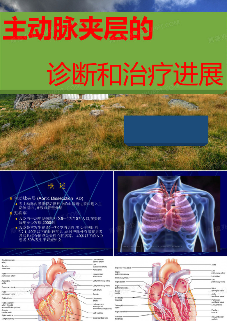 主动脉夹层