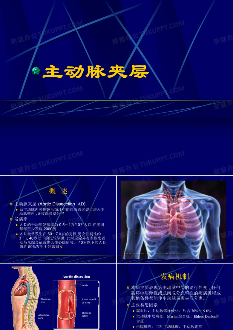 主动脉夹层