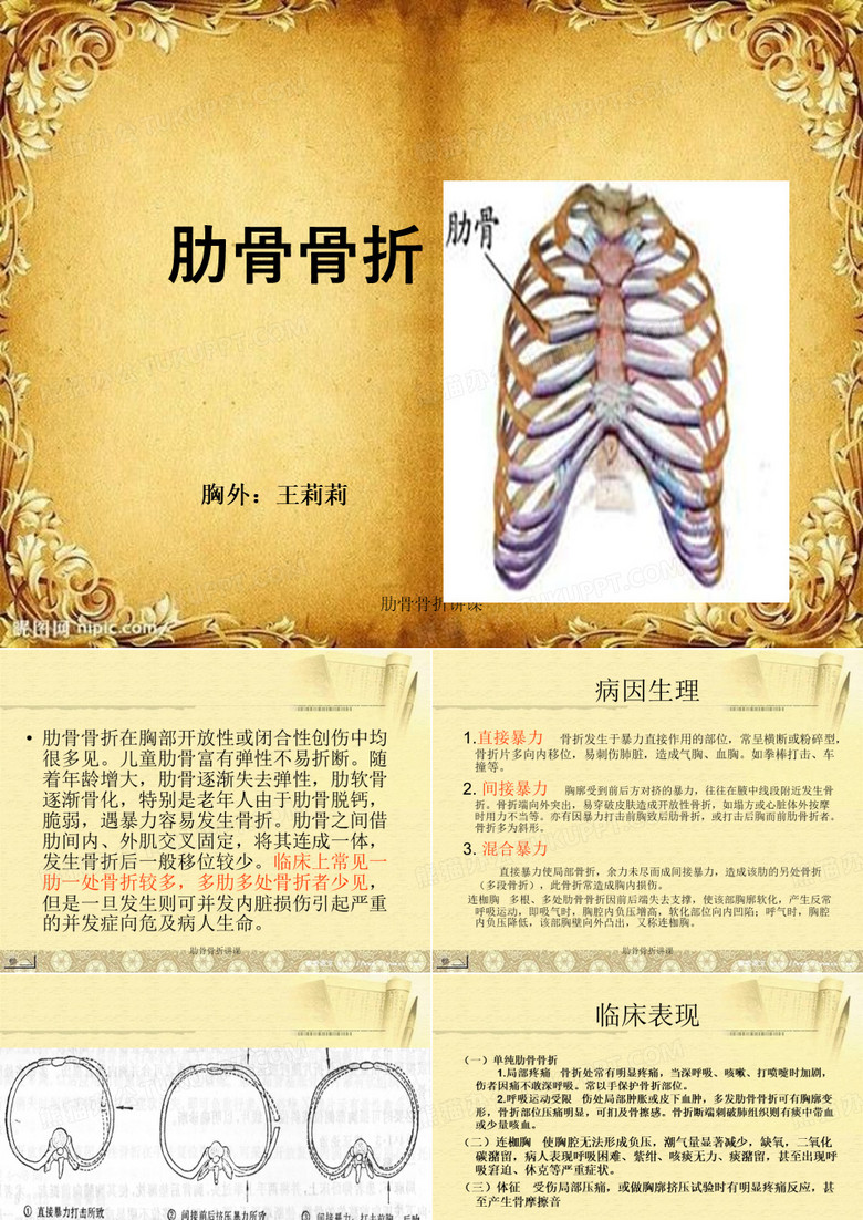 肋骨骨折讲课