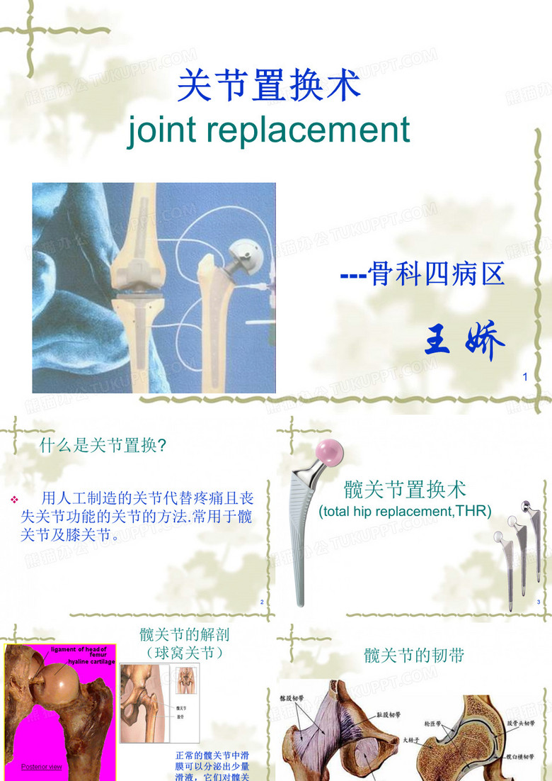 髋关节置换