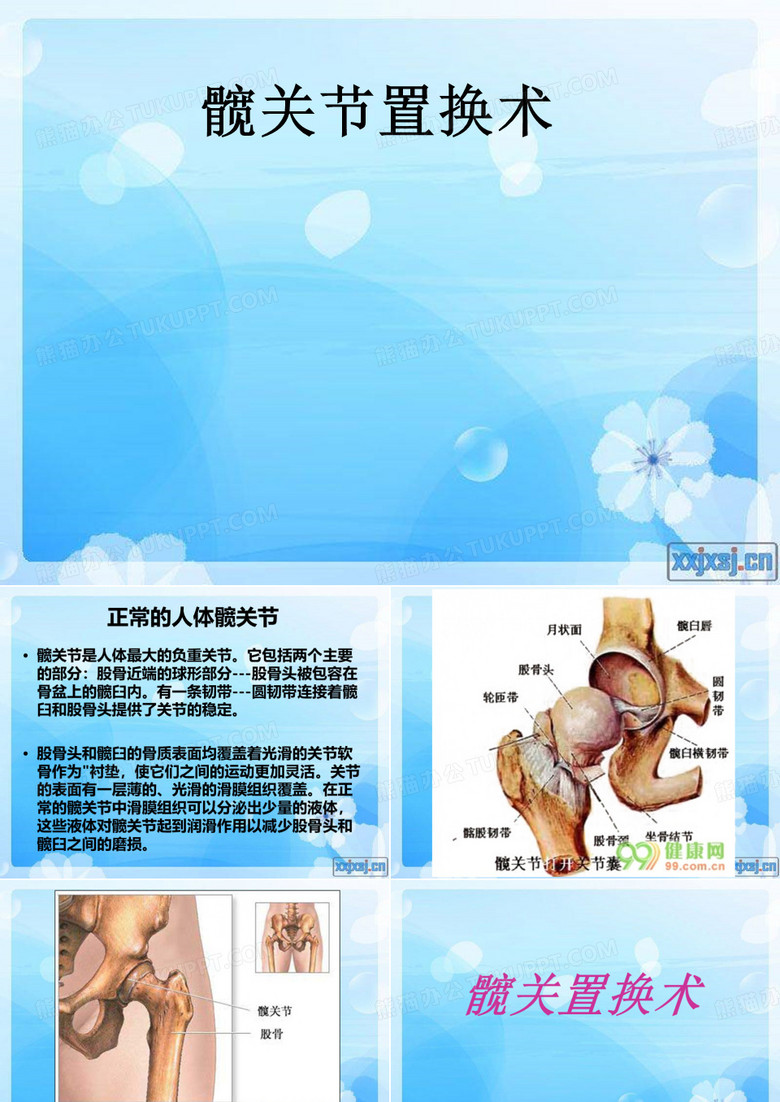 髋关节的置换