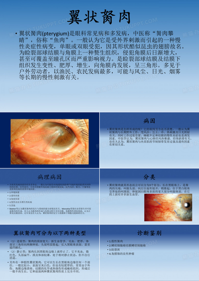 翼状胬肉