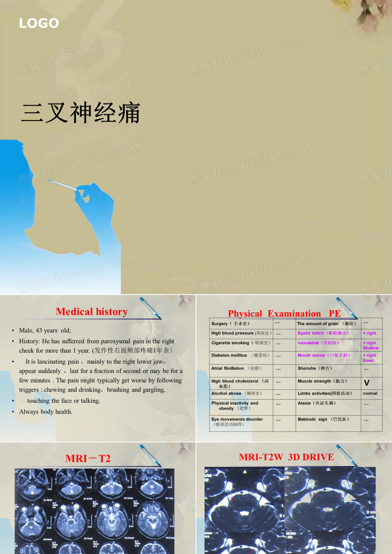 三叉神经痛