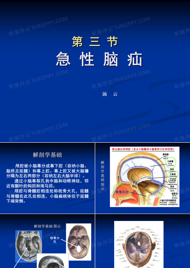 脑疝