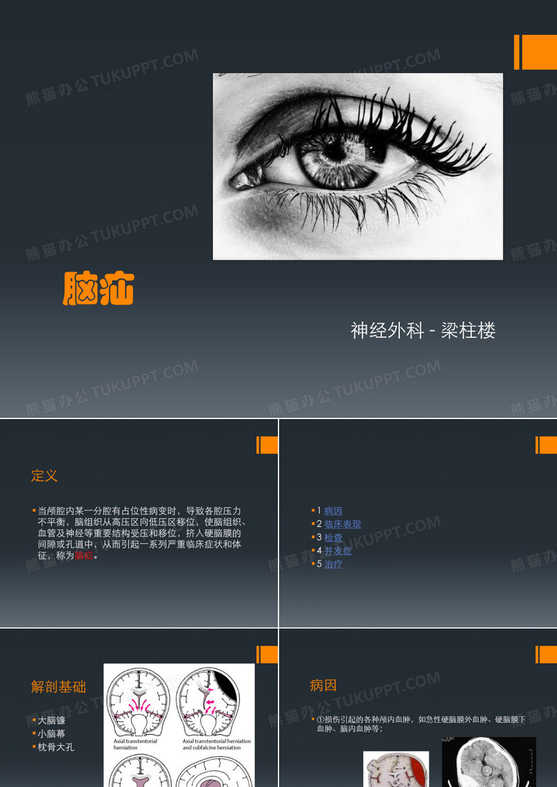 脑疝