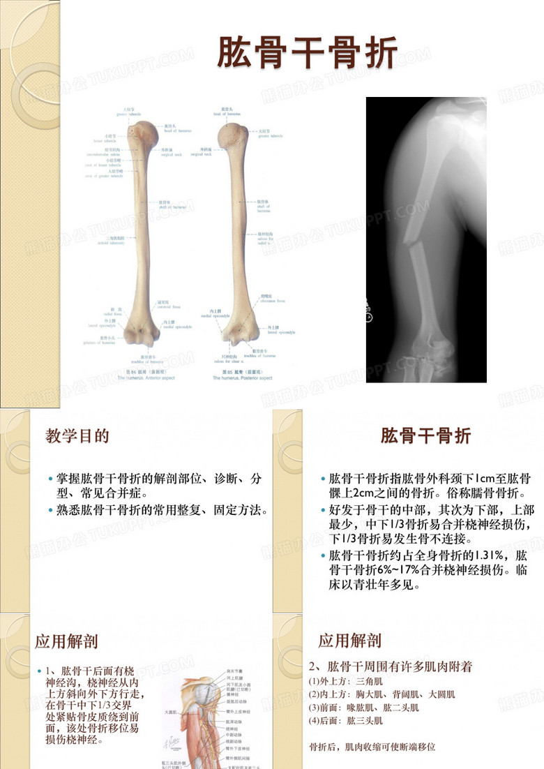 肱骨干骨折