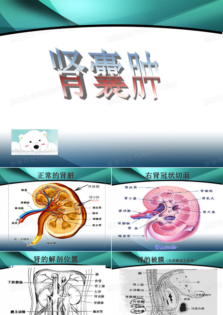 肾囊肿_幻灯片