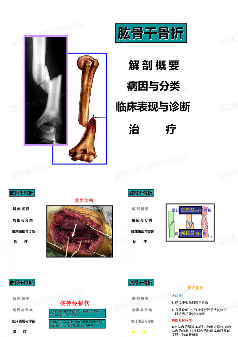 肱骨干骨折PPT