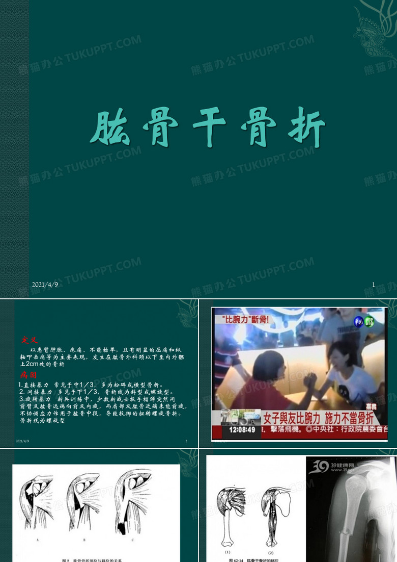 肱骨干骨折