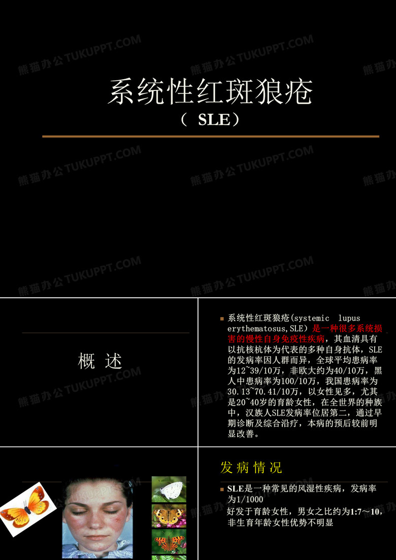 系统性红斑狼疮
