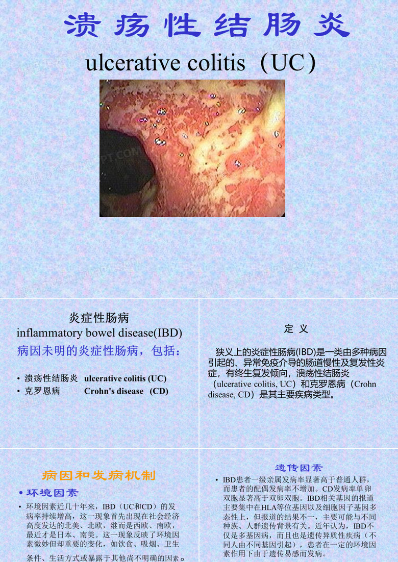 溃疡性结肠炎