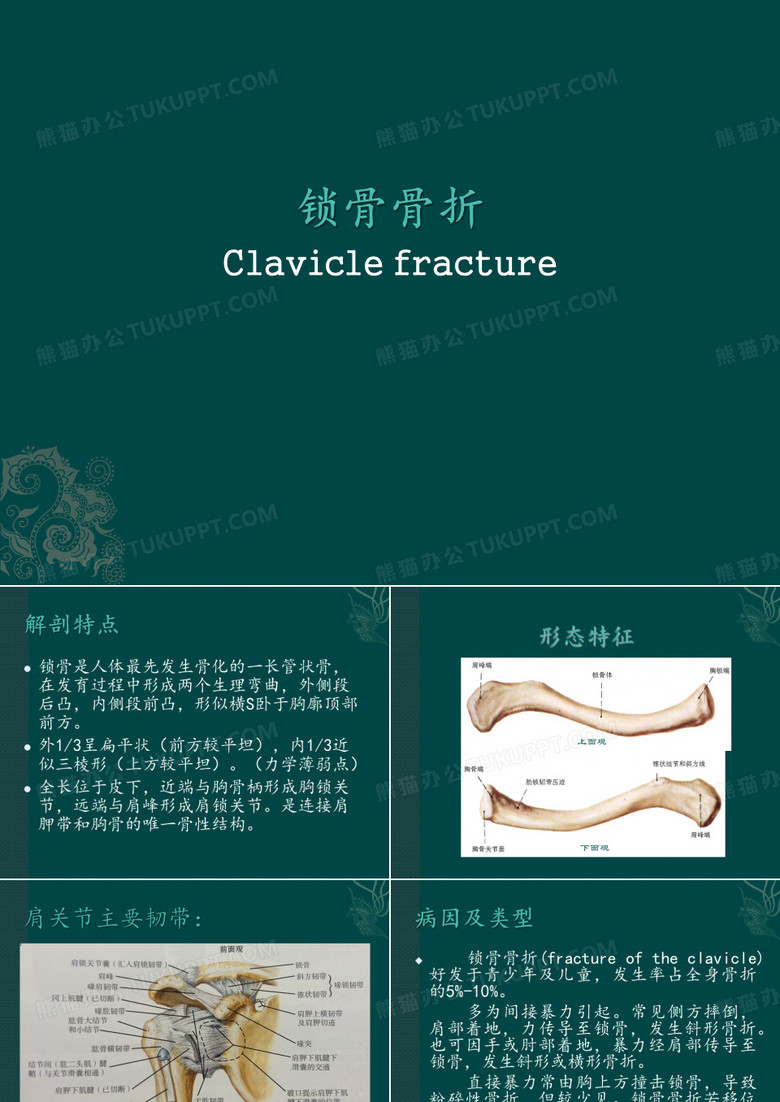 锁骨骨折