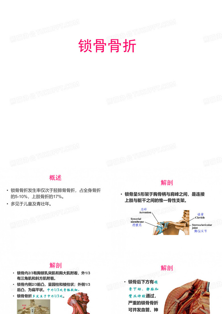 锁骨骨折