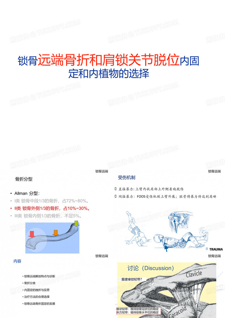 锁骨远端骨折