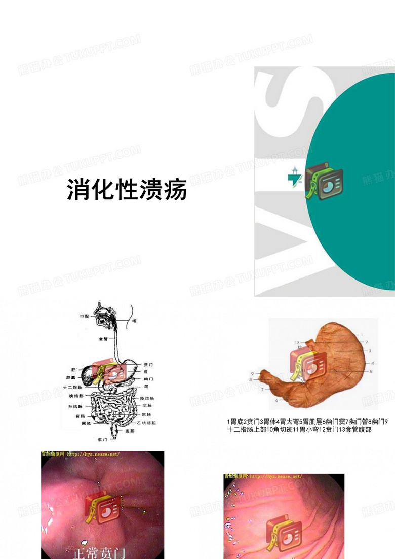 消化性溃疡课件