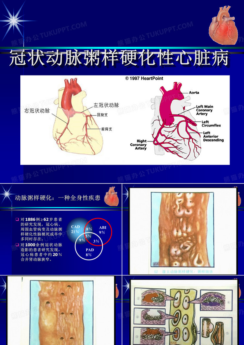 冠状动脉粥样硬化性心脏病