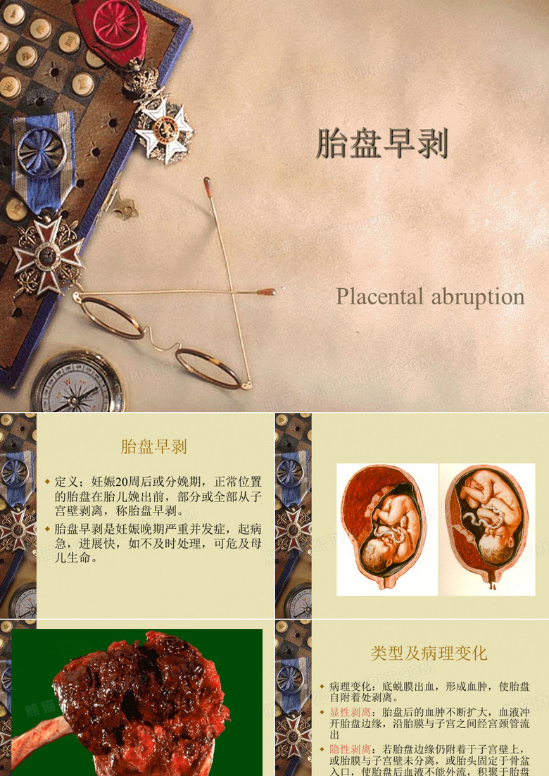 胎盘早剥