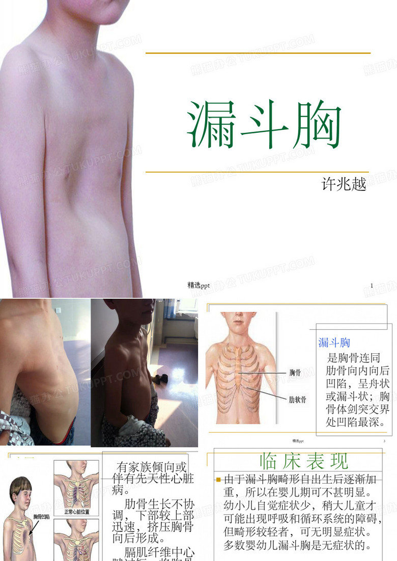 漏斗胸_ppt