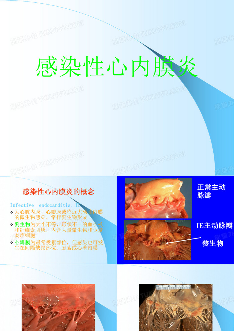 感染性心内膜炎