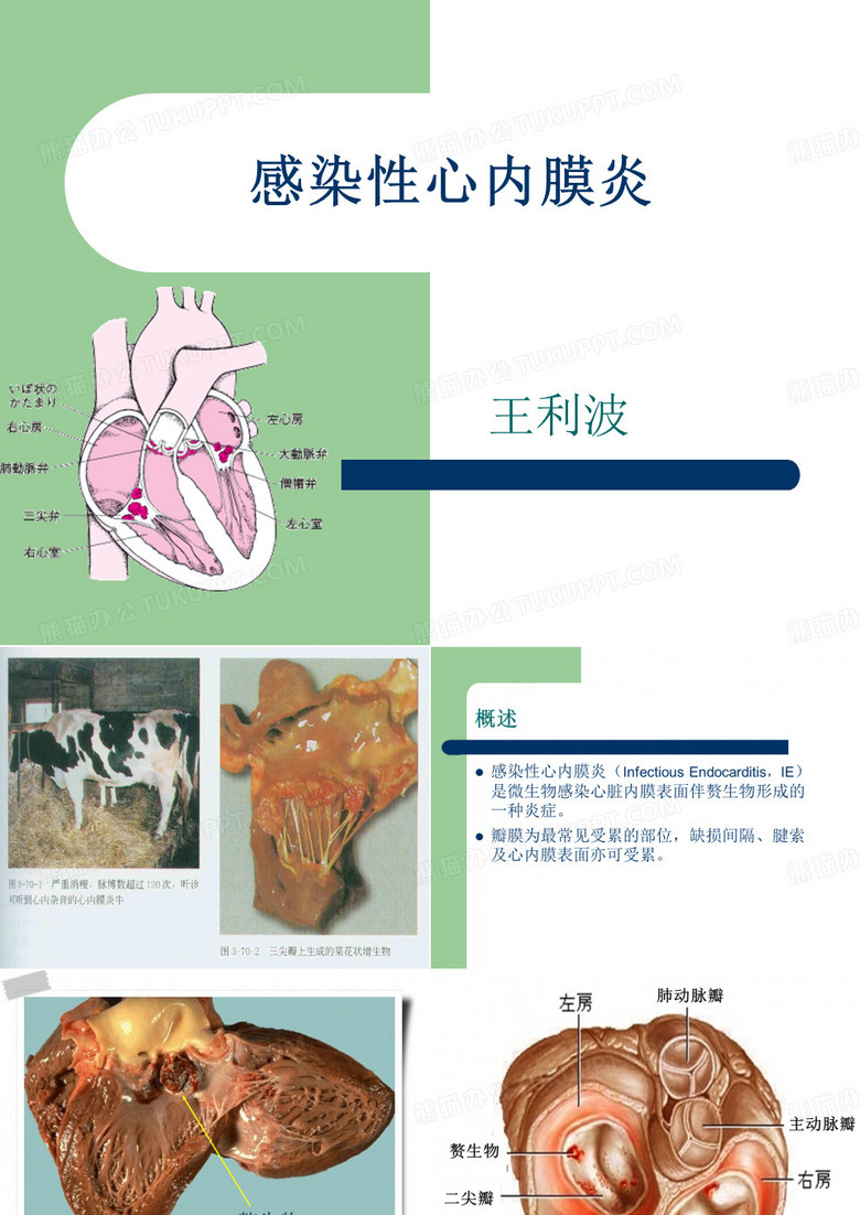 感染性心内膜炎
