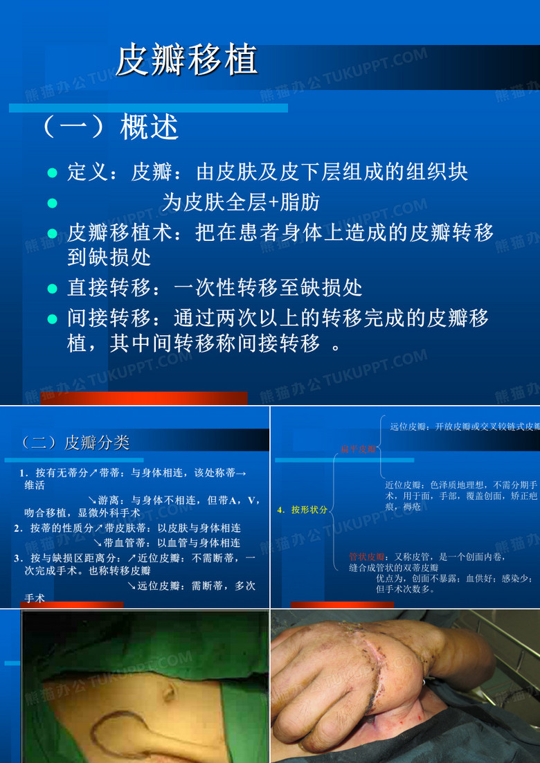 皮瓣移植
