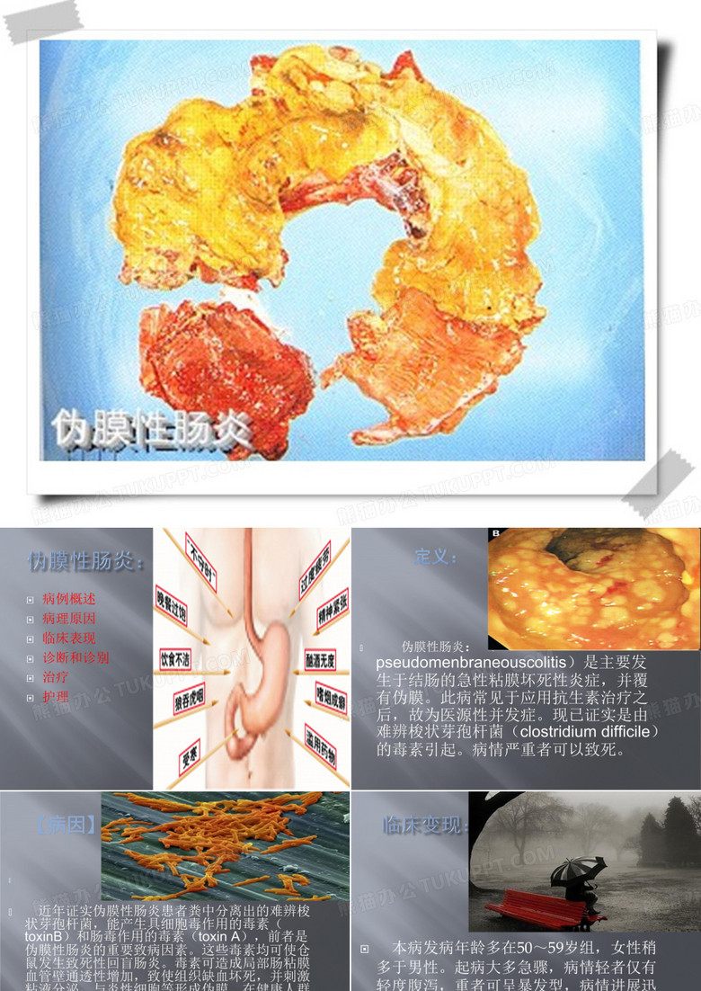 伪膜性肠炎