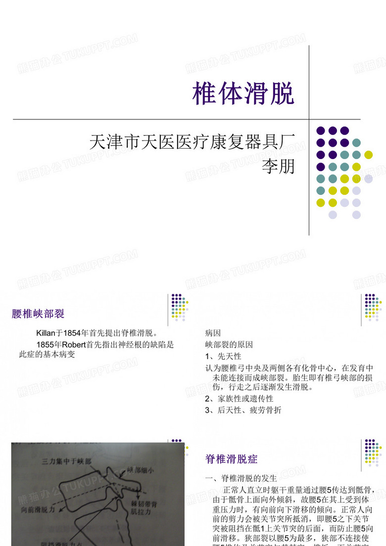 脊椎滑脱