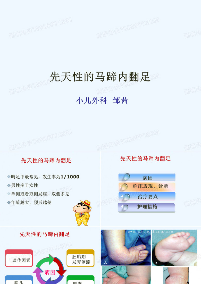 先天性马蹄足