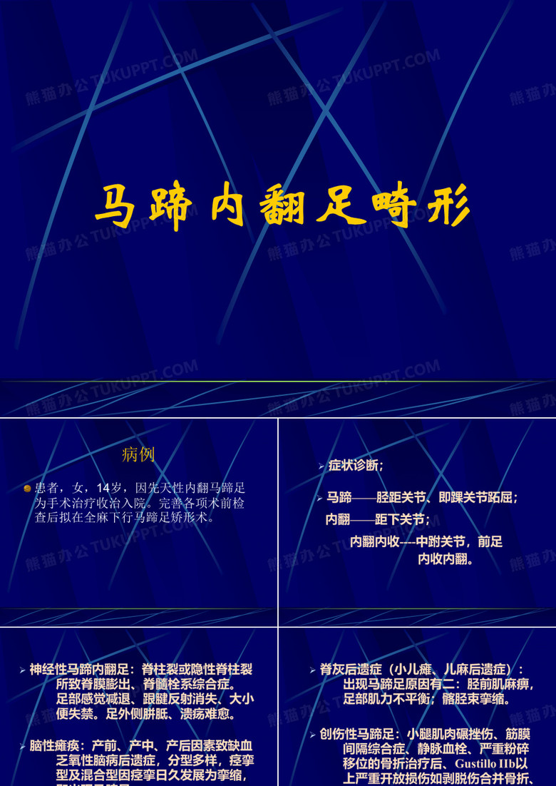 马蹄内翻足畸形