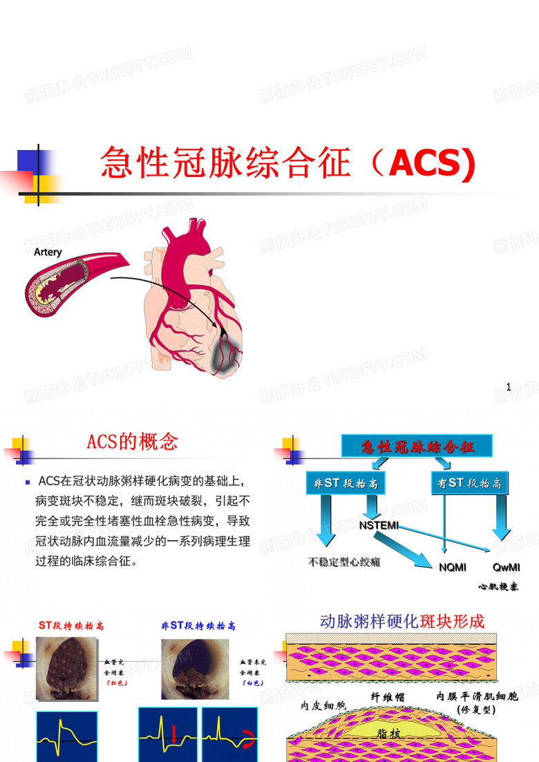 急性冠脉综合征
