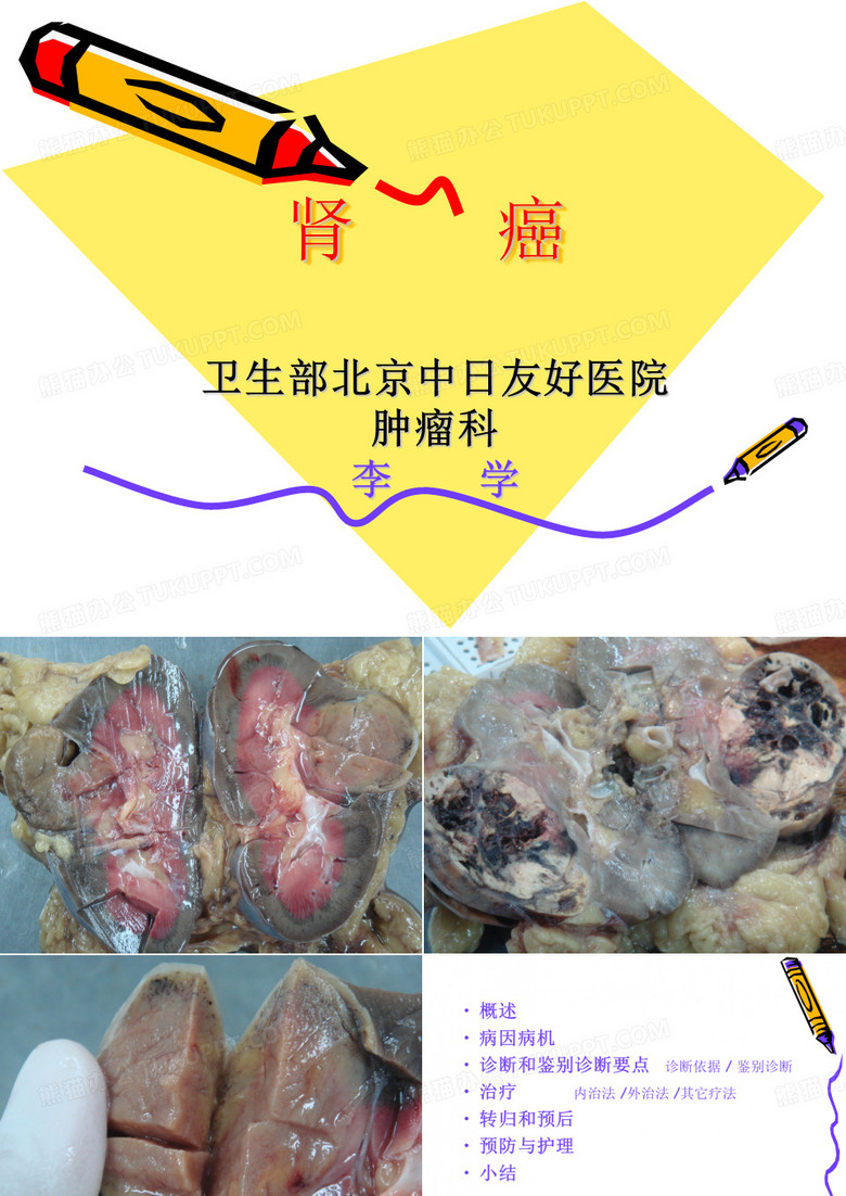 肾癌