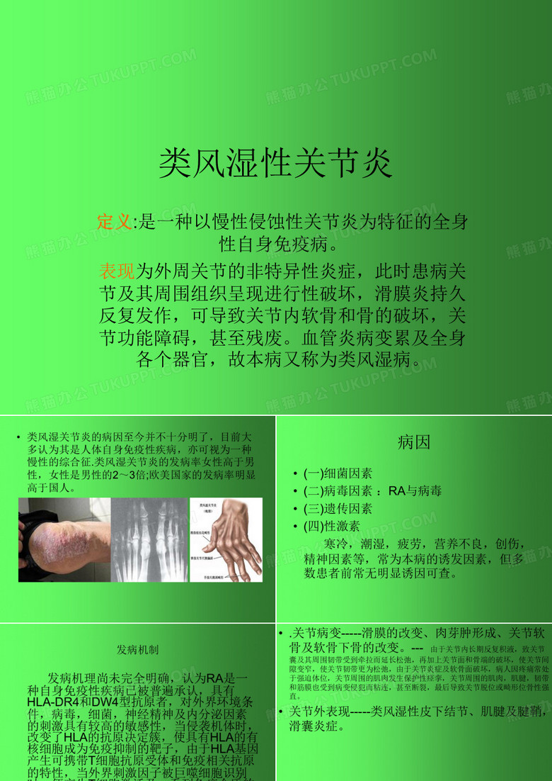 类风湿性关节炎