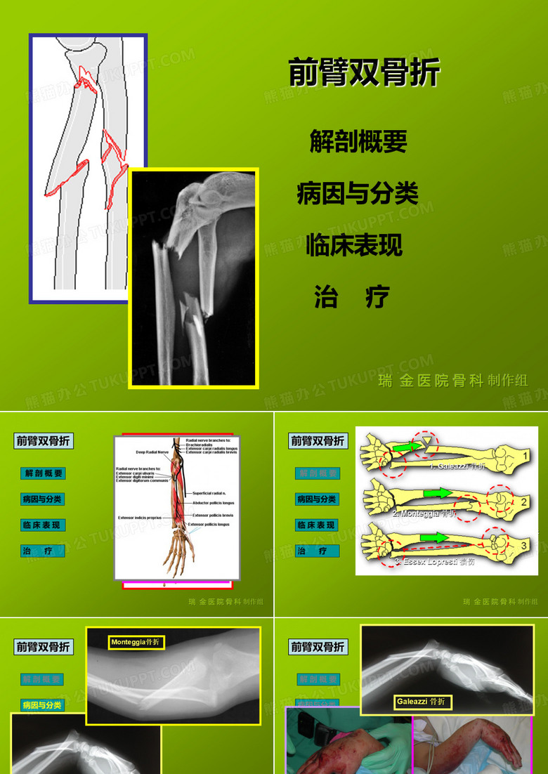 前臂双骨折