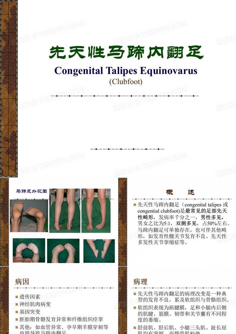 先天性马蹄内翻