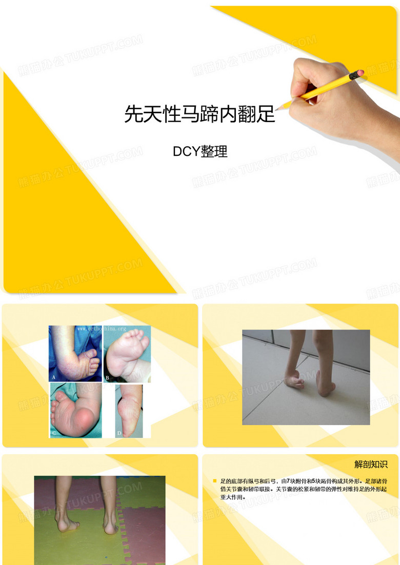 先天性马蹄内翻足