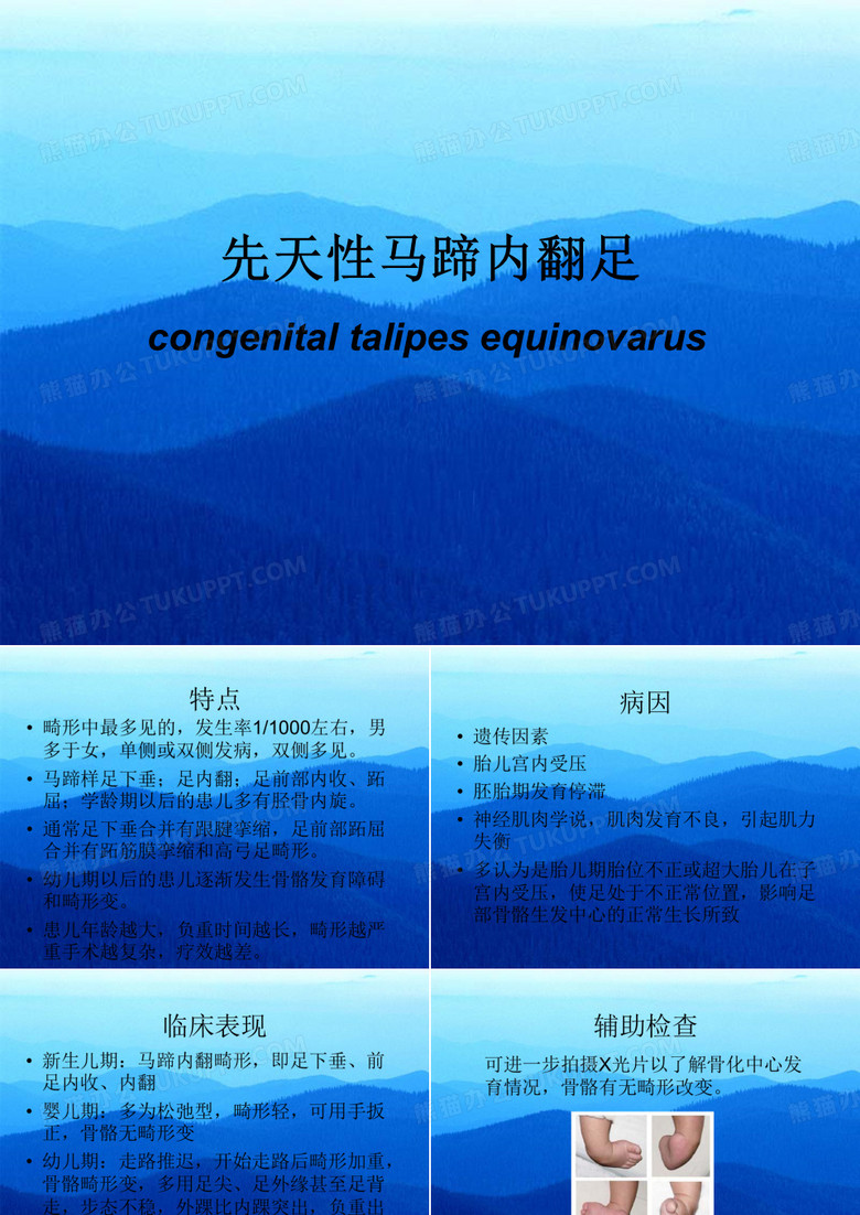 先天性马蹄足内翻