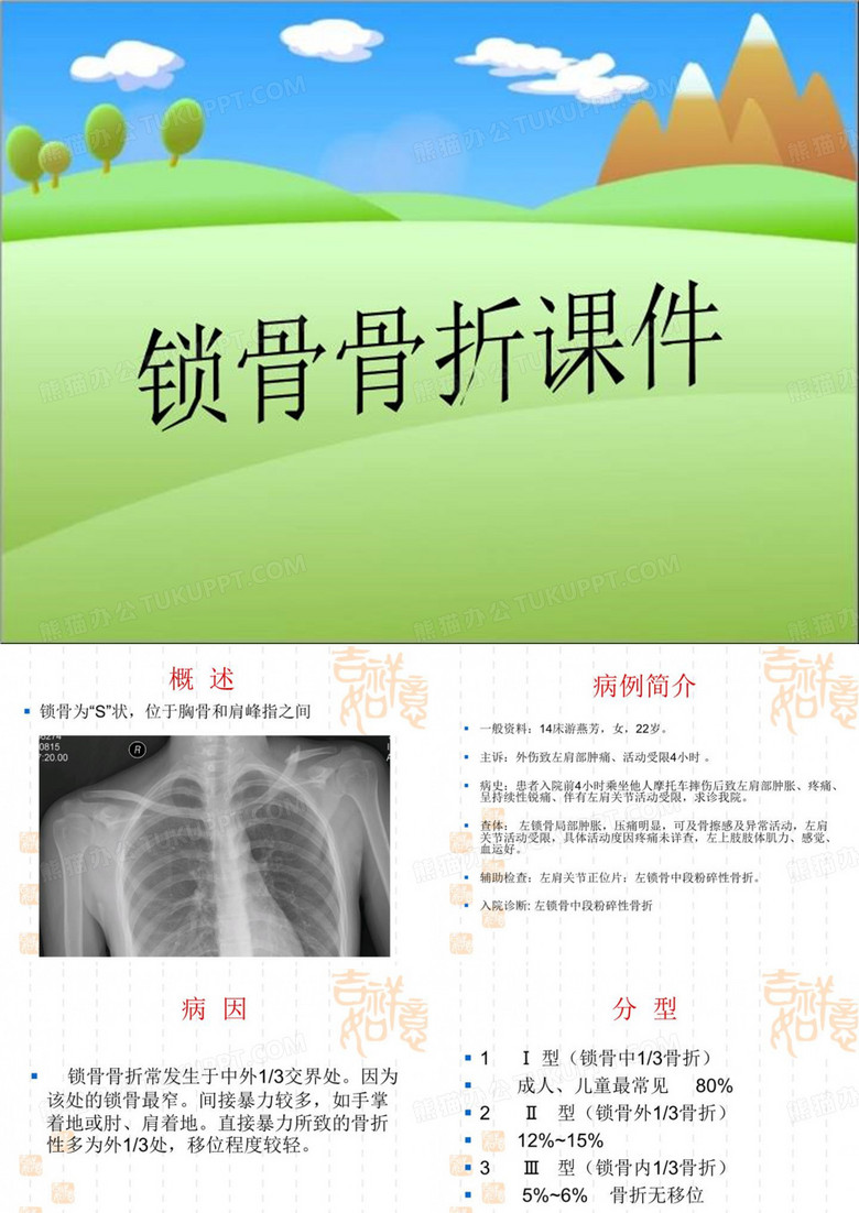 锁骨骨折课件