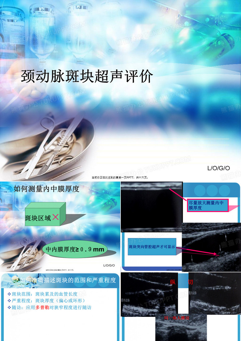 颈动脉斑块超声评价