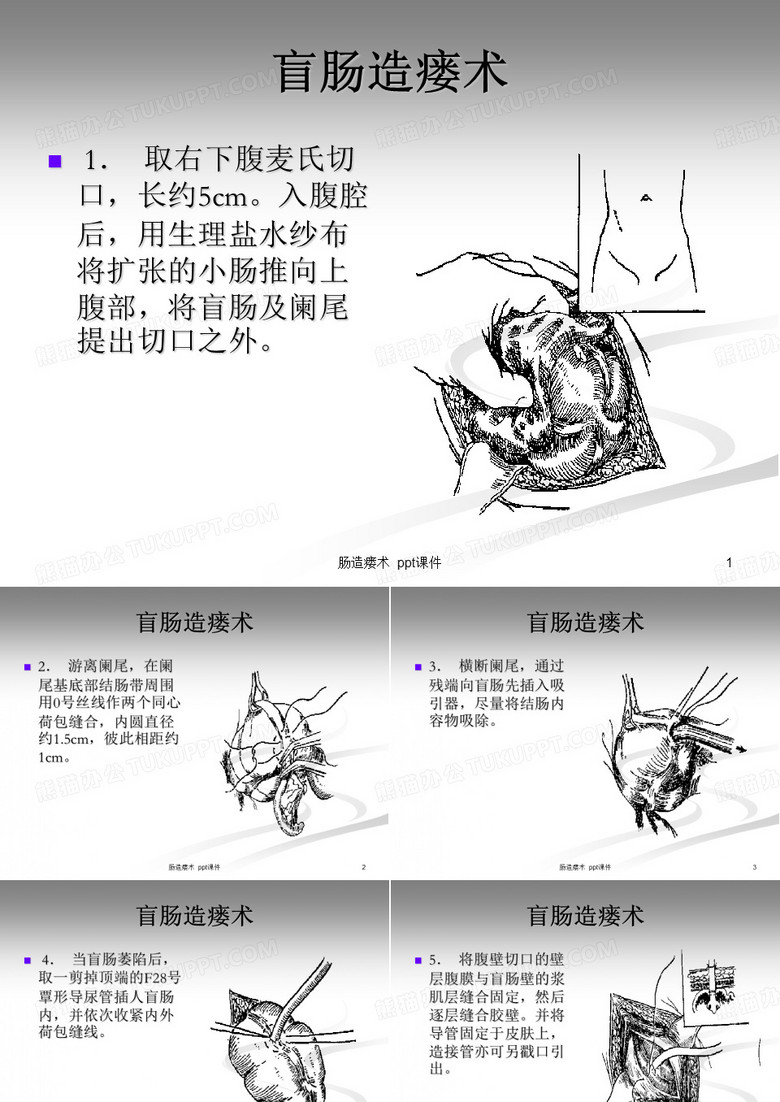 肠造瘘术 ppt课件