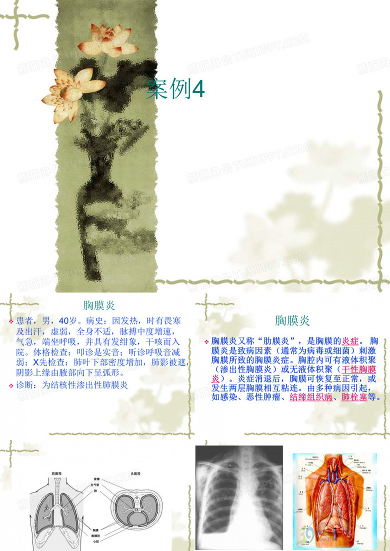 胸膜炎