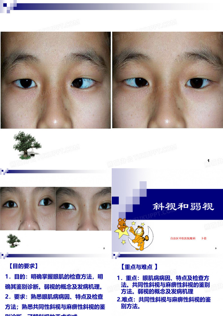 斜视与弱视