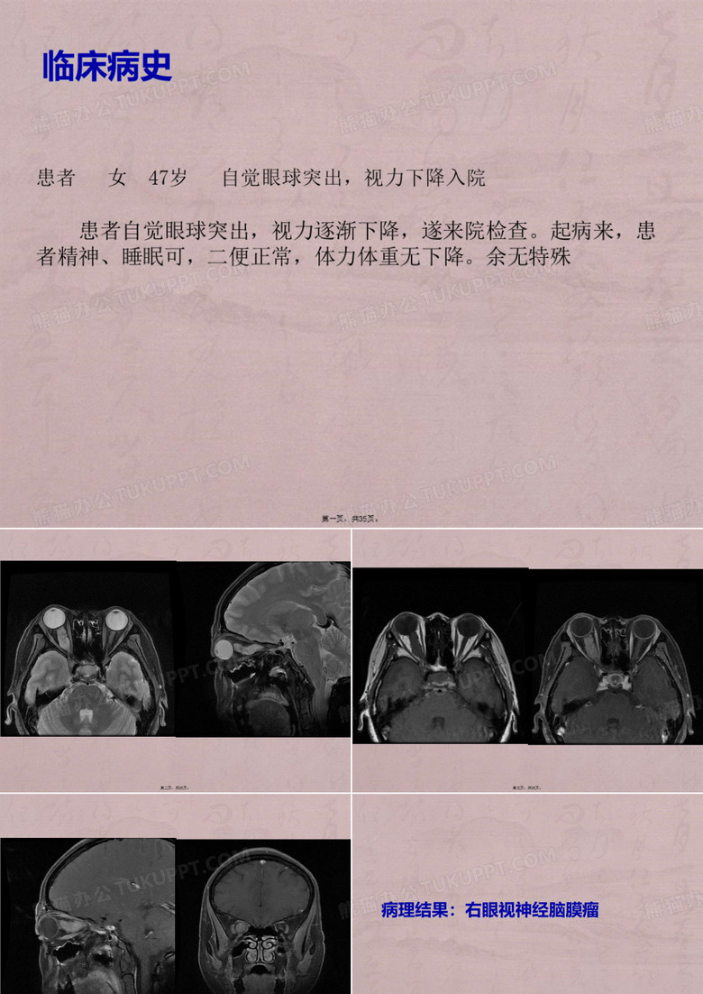 视神经脑膜瘤
