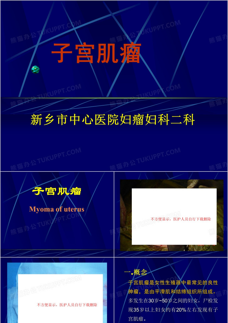 子宫肌瘤