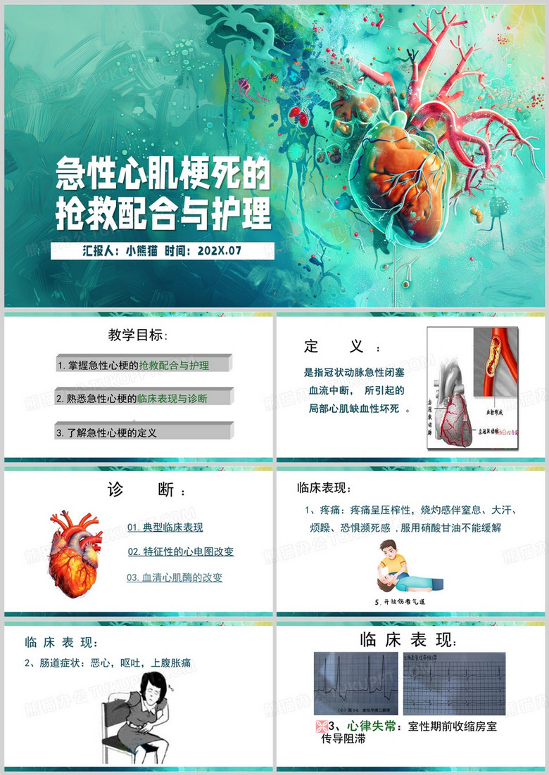 綠色簡約風(fēng)急性心肌梗死PPT模板